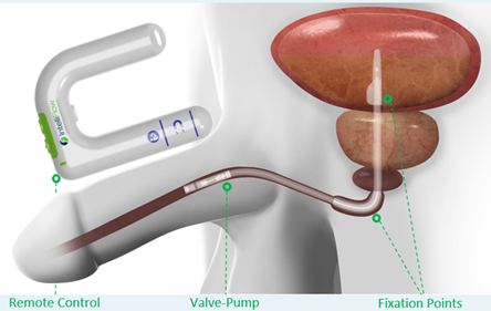 Vesiflo Announces a New Male Device to Replace Urinary Catheters